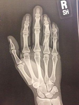 x ray of broken finger
